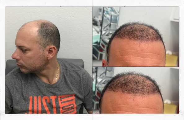 Before and After FUE hair transplant