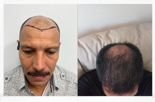 Before and After Follicular Unit Extraction hair transplant