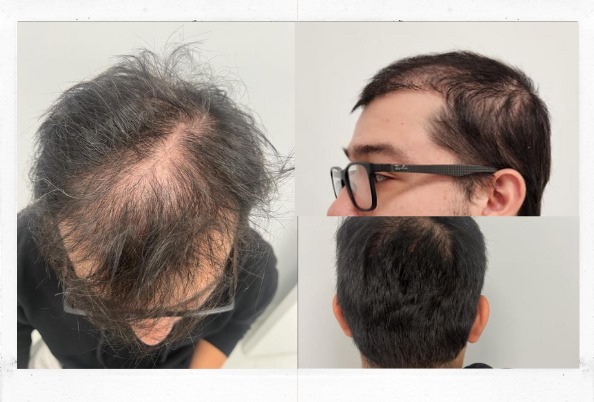 Before and After hair restauration