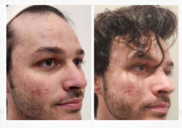 Before and After FUE hair treatment