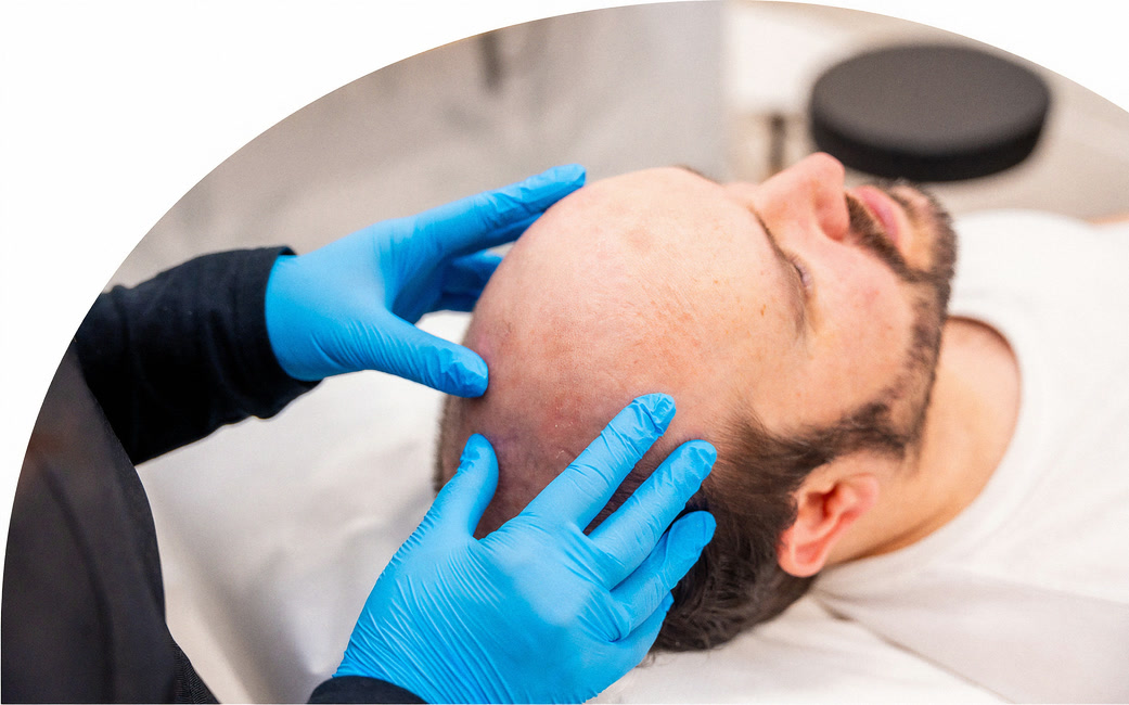hair transplant FUE, trasplante capilar en Miami Lakes
