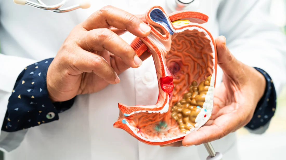 Erectile dysfunction (ED) is a common and concerning side effect many men face after prostate removal surgery. operación de próstata